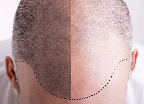 کاشت پیوند موی طبیعی به روش‌ FIT و FUT