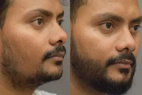 کاشت ریش