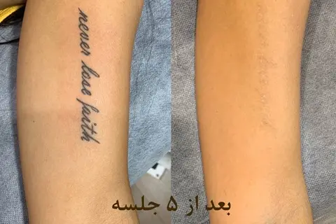 برداشتن تتو با دستگاه Q سوئیچ