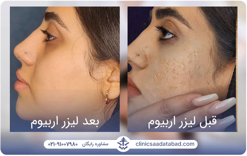 تصاویر قبل و بعد لیزر اربیوم سعادت آباد