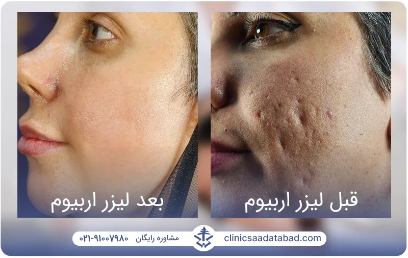 تصاویر قبل و بعد لیزر اربیوم 