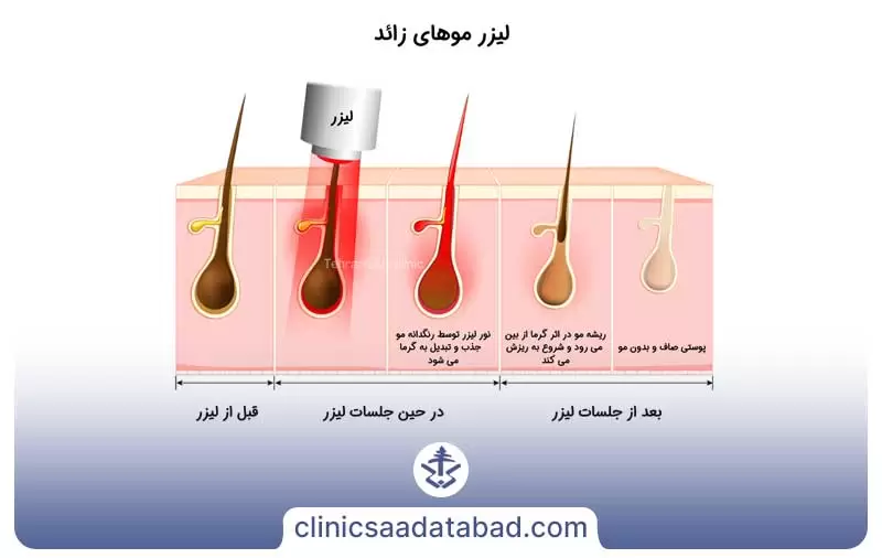 لیزر مو زائد