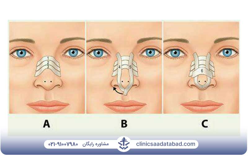 عکس قبل و بعد لیفت بینی با نخ