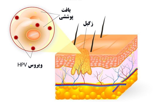 درمان زگیل تناسلی