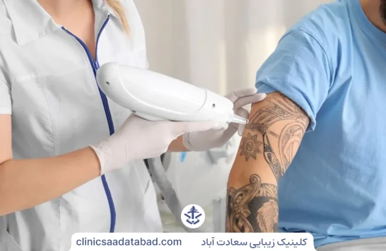 پاک کردن تاتو با لیزر