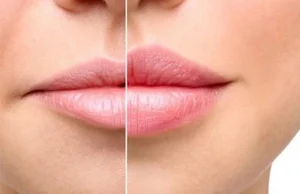 تزریق چربی به لب