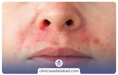 انواع اگزما