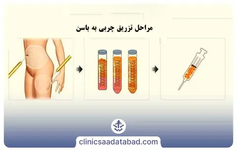 مراحل برداشت و تزریق چربی