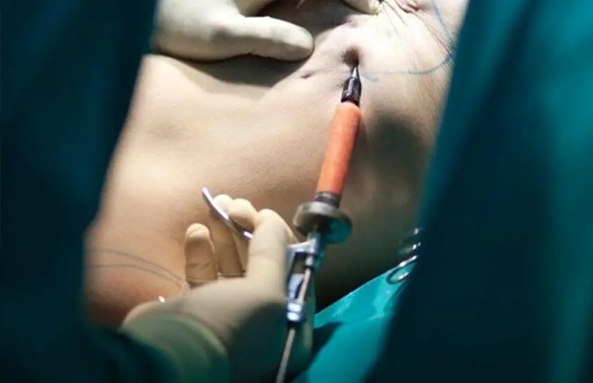 توصیه‌های قبل از تزریق چربی به سینه