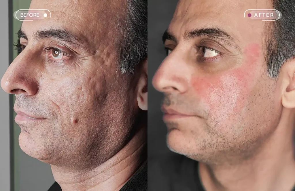 عکس قبل و بعد از لیزر اربیوم