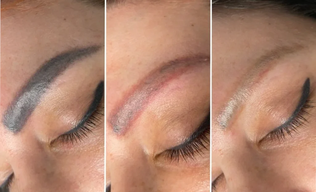 پاک کردن تتوی ابرو طی چند جلسه