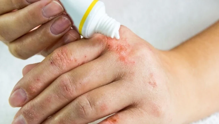 بهترین پماد برای اگزمای پوستی
