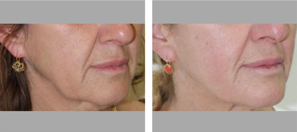 نحوه اثر اندولییفت 