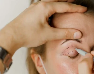 دوره نقاهت بلفاروپلاستی