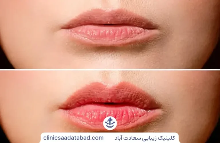 ژل لب نچرال