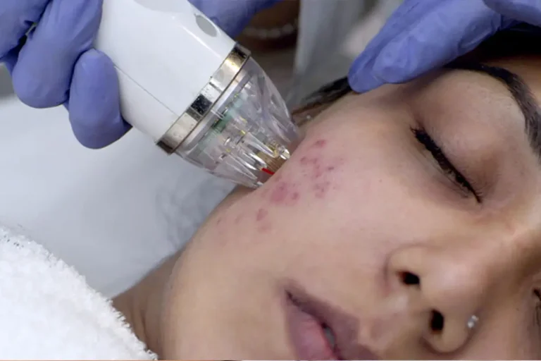 مراقبت های بعد از سابسیژن