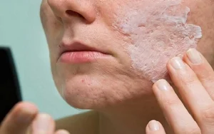 درمان جای جوش