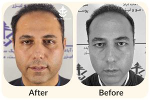 مراقبت های قبل و بعد از بلفاروپلاستی