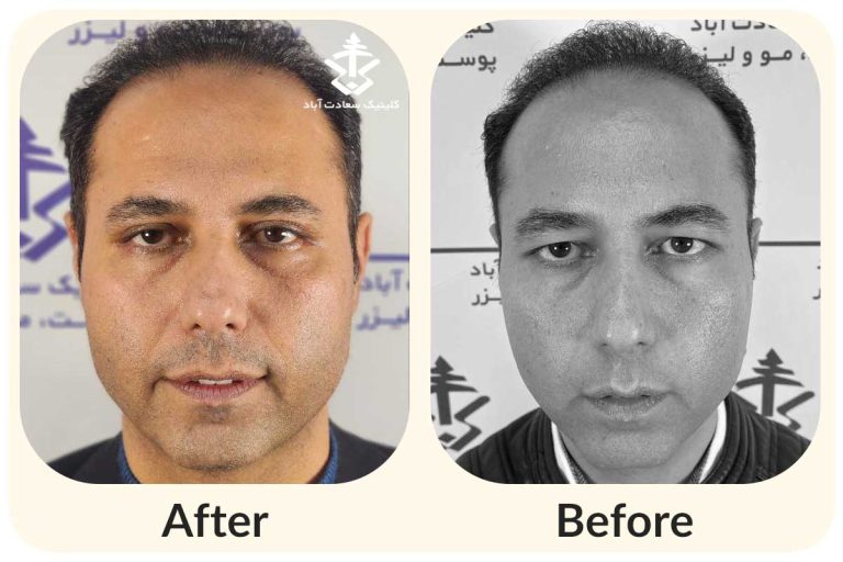 مراقبت های قبل و بعد از بلفاروپلاستی