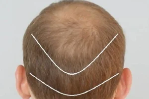 کاشت مو چند ساعت طول می کشد؟