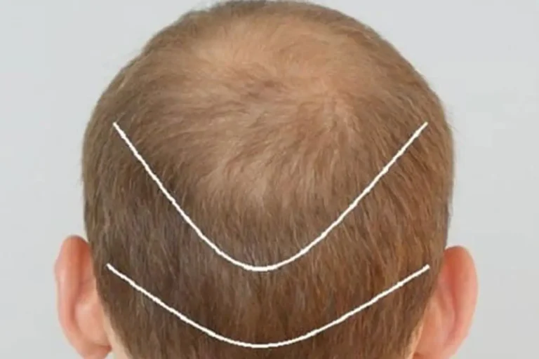 کاشت مو چند ساعت طول می کشد؟