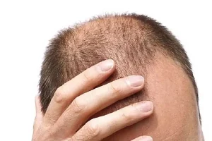 عفونت بعد از کاشت مو