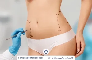 پیکر تراشی با لیپوماتیک