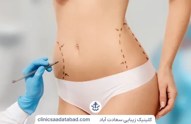 پیکر تراشی با لیپوماتیک