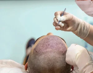 كاشت مو به روش تكثير