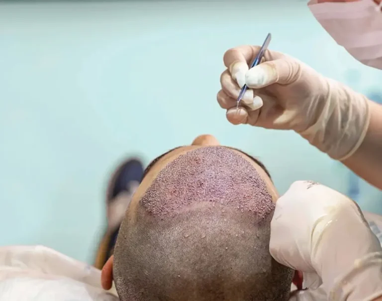 كاشت مو به روش تكثير