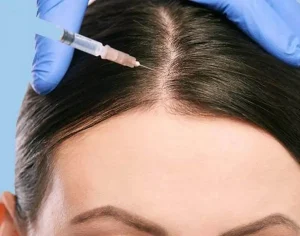 کوکتل مزوتراپی مو