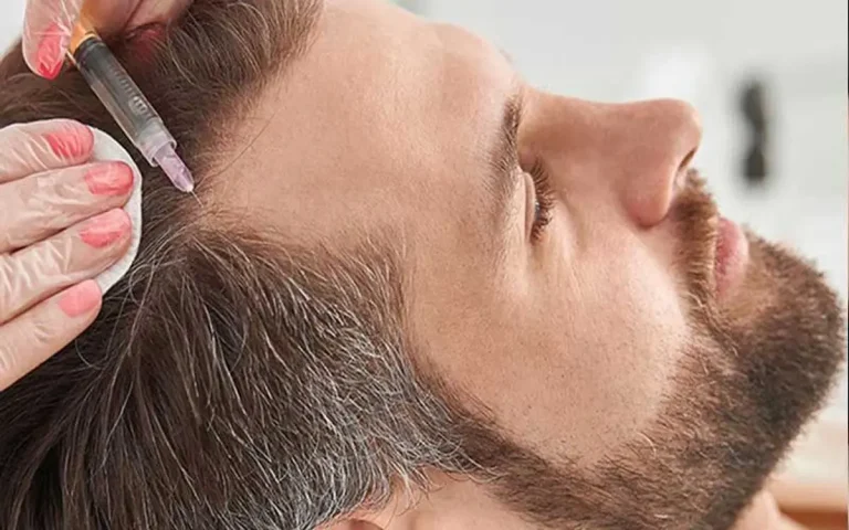 مزوتراپی و جلوگیری از ریزش مو