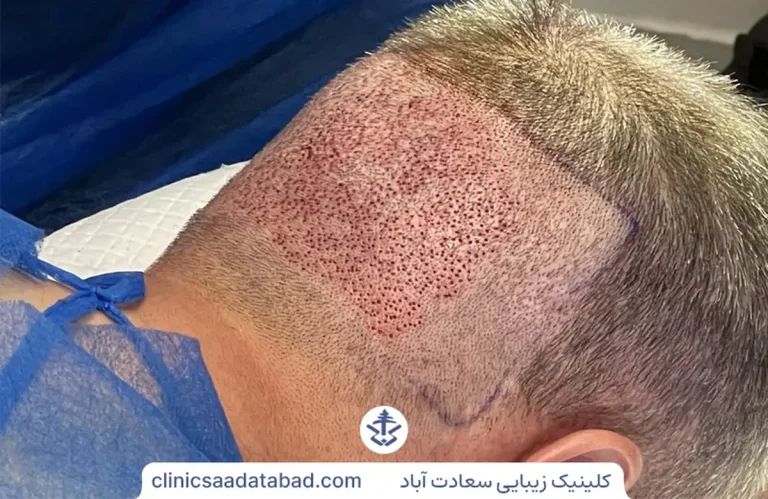 کاشت مو به روش fit