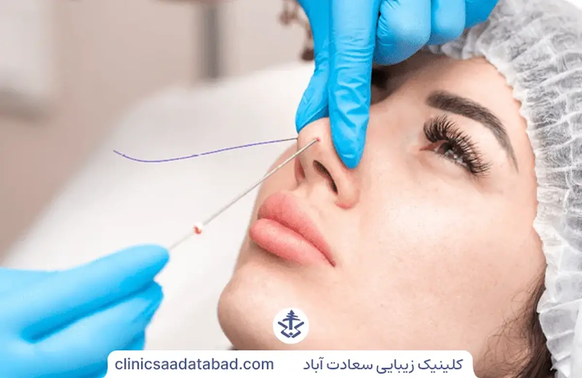 لیفت بینی با نخ