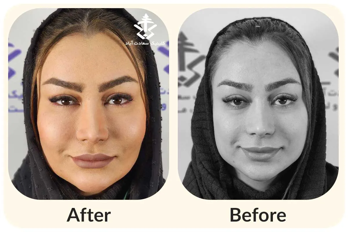 مراقبت بعد از تزریق چربی