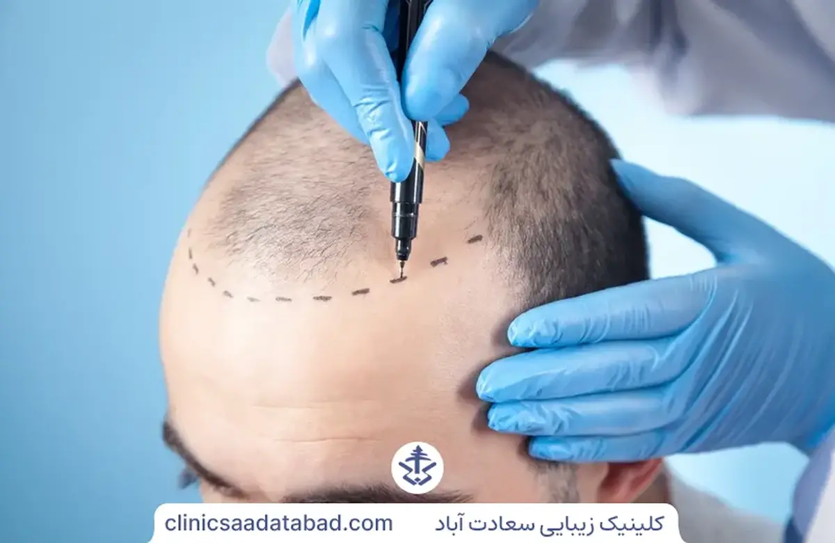 کاشت مو به روش sut