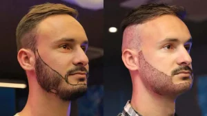 دوره نقاهت بعد از کاشت ریش