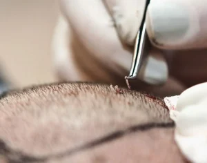 ماندگاری موهای کاشته شده