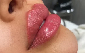 مسواک زدن بعد از تزریق ژل لب