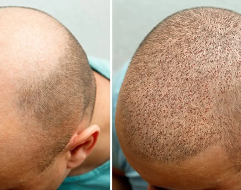 نقاهت بعد از کاشت مو