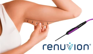 Renuvion-versus-BodyTite-2 (2)