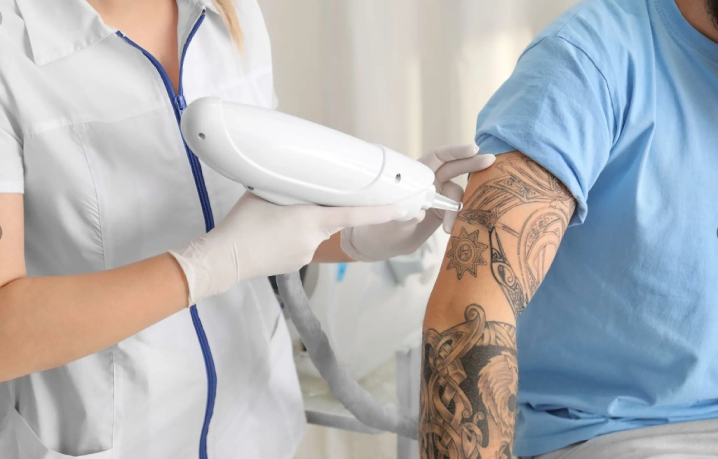 پاک کردن تتو با لیزر 