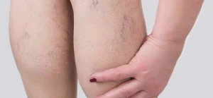 عکس واریس خفیف پا تا شدید