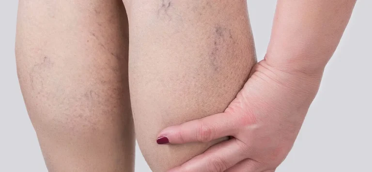 عکس واریس خفیف پا تا شدید