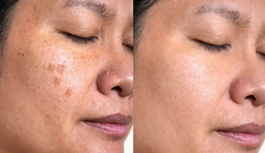 رفع کک و مک با لیزر کیوسوئیچ