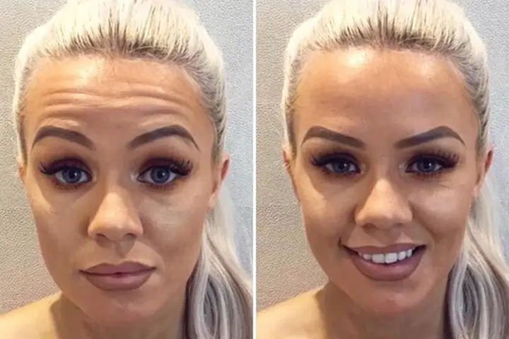 بوتاکس برای کاهش چین و چروک‌