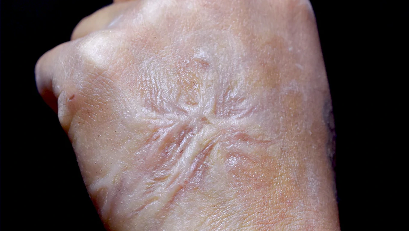 بهترین روش درمان جای سوختگی