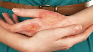 درمان جای سوختگی