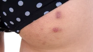 درمان جوش باسن