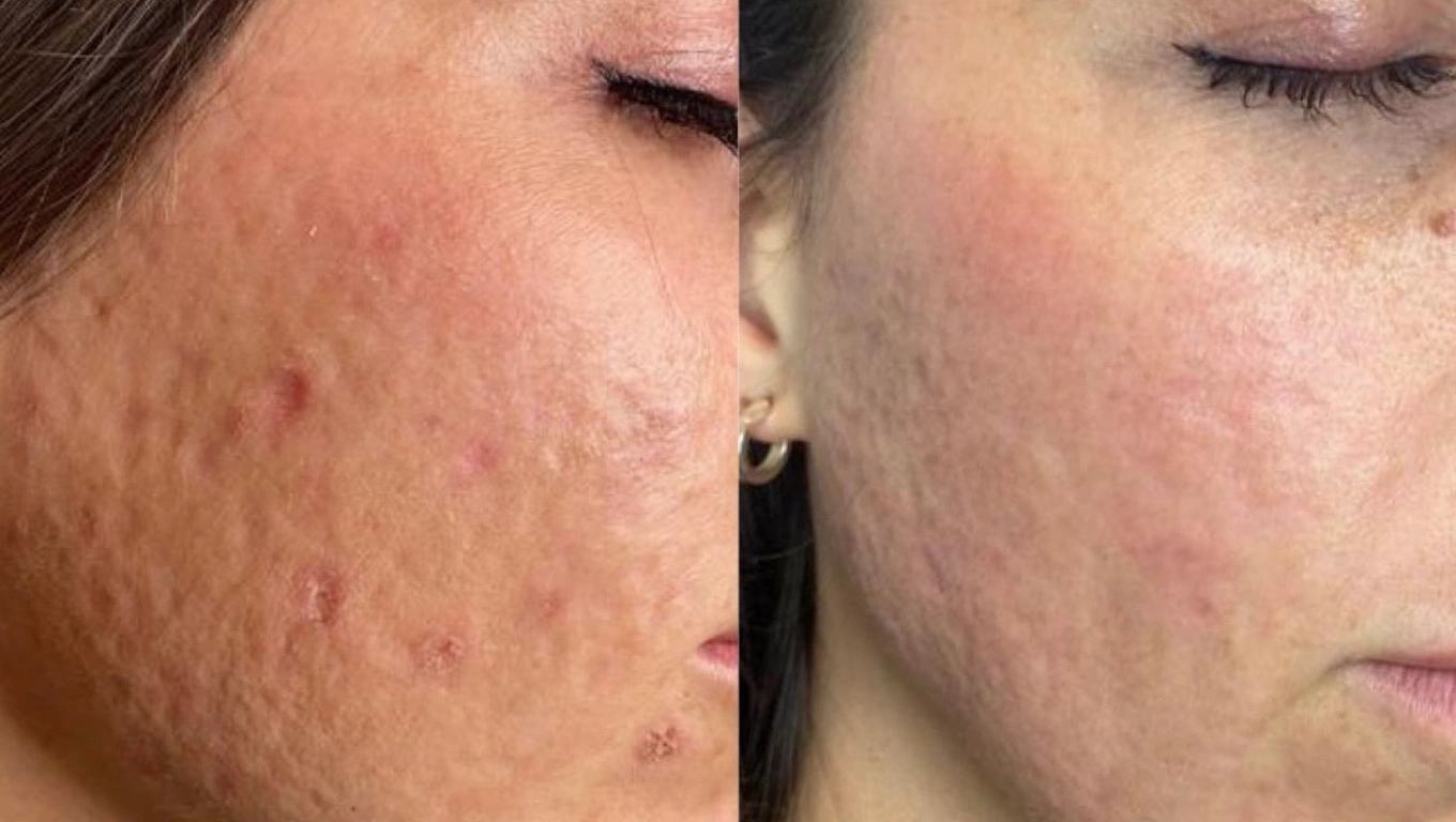 کاربرد لیزر CO2 فرکشنال